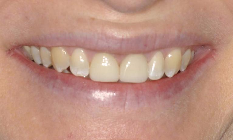 Crowns-Cosmetic-Dentistry-After-Image