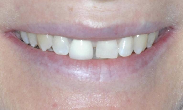 Crowns-Cosmetic-Dentistry-Before-Image